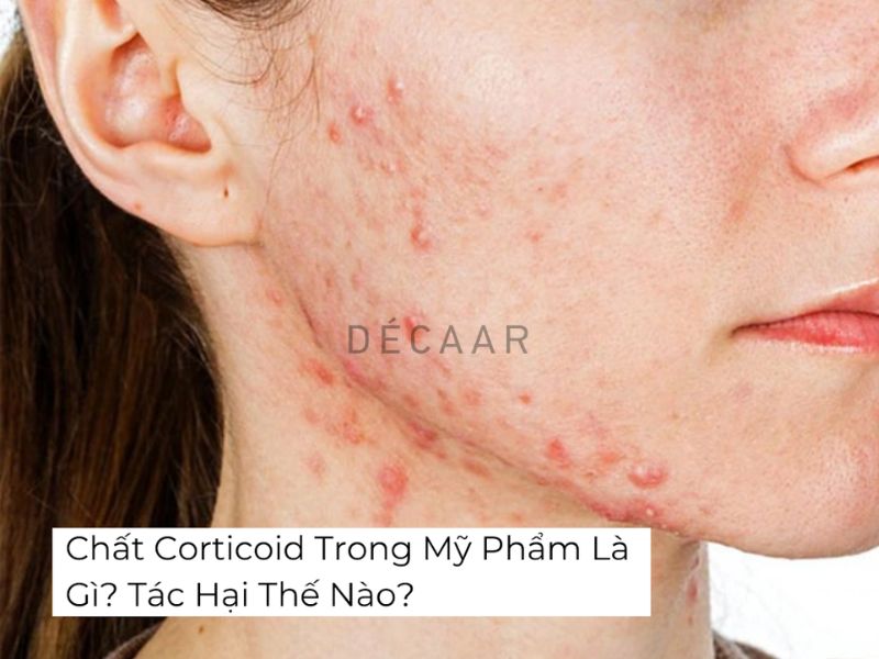 chất corticoid trong mỹ phẩm